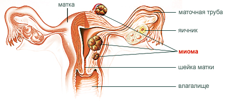 Киста яичника: симптомы, лечение, операция9