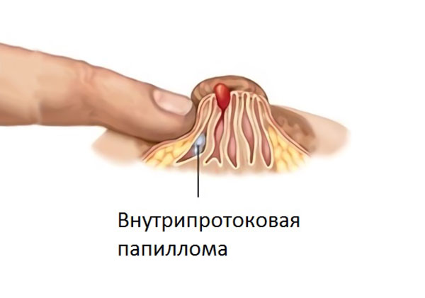 Киста молочной железы: причины, диагностика, лечение9