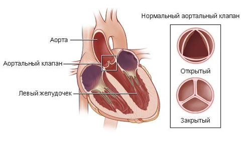 Надклапанный стеноз аорты. Синдром Williams9