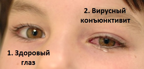 Конъюнктивит у детей: лечение, симптомы,  профилактика, фото9