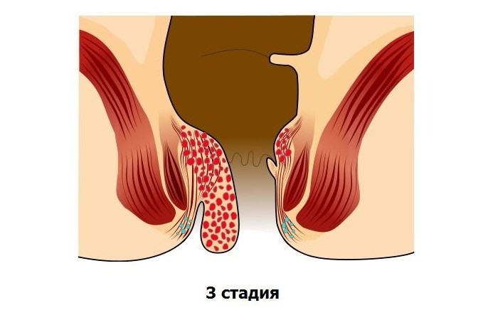 Внутренний геморрой: симптомы, лечение, причины возникновения9