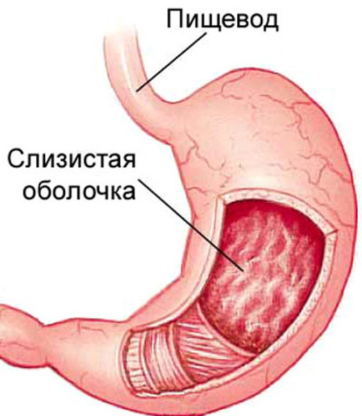 Гастрит: симптомы, виды, лечение поверхностного гастрита9