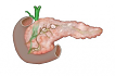 Киста поджелудочной железы