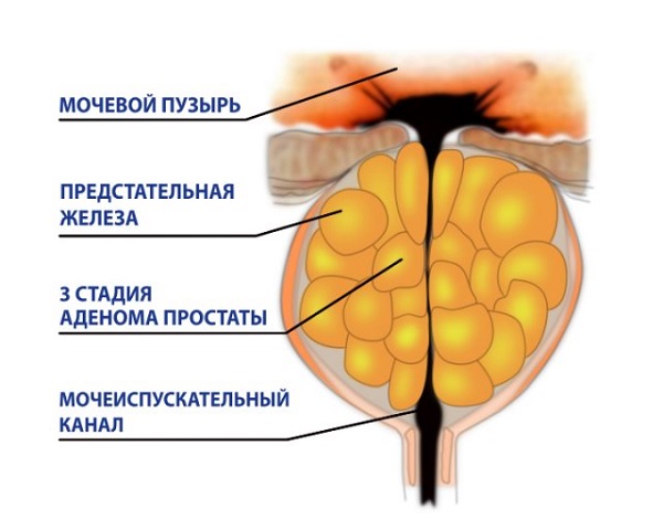 Аденома простаты 3434