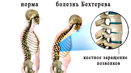 Болезнь Бехтерева 232