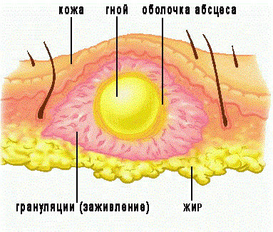 абсцесс схема