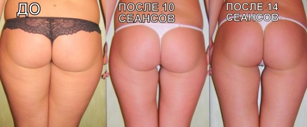 Медовый массаж до и после
