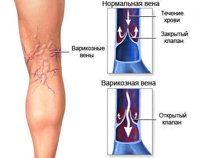 Варикозное расширение вен 2