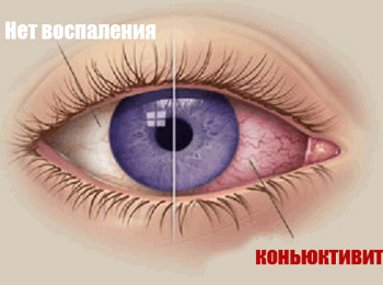 Аллергический конъюнктивит 2