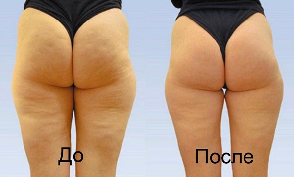 Медовый массаж до и после 3