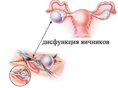 Дисфункция яичников фото