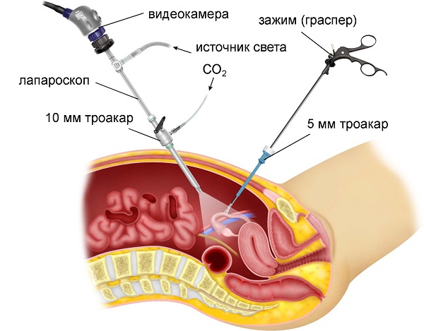 Лапароскопия