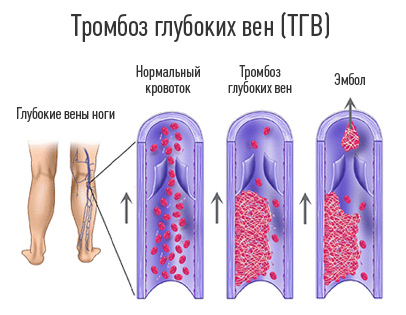 Тромбофлебит нижних конечностей фото схема