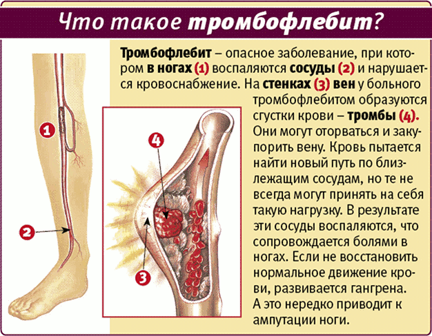 Тромбофлебит нижних конечностей фото 2