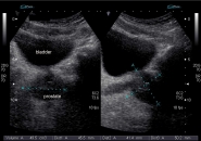Аденома простаты узи фото