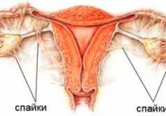 Спайки в малом тазу 343