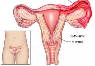 Воспаление придатков у женщин 23