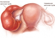 Воспаление придатков у женщин 2323