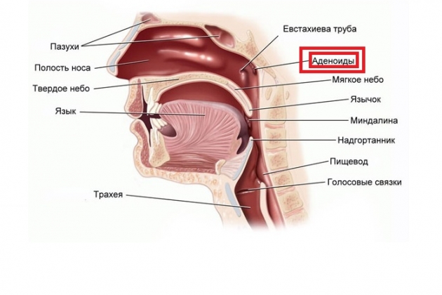 Аденоиды