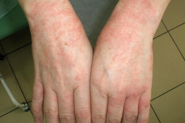 Экзема начальная стадия Экзема начальная стадия