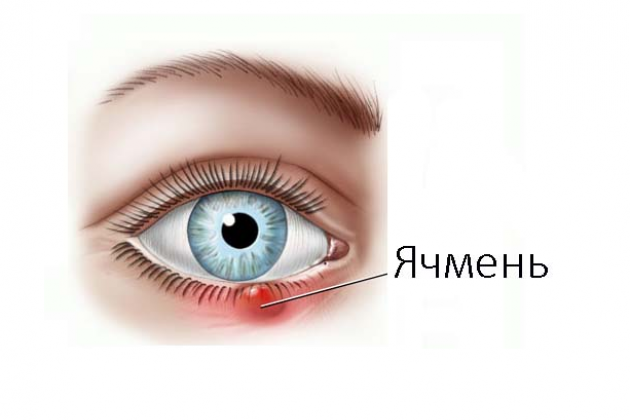 Ячмень на глазу