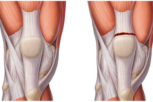 Повреждение связки надколенника