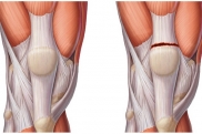 Повреждение связки надколенника