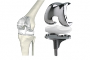 Эндопротезирование коленного сустава Эндопротезирование коленного сустава